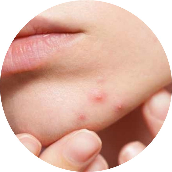 Acne & Pimples