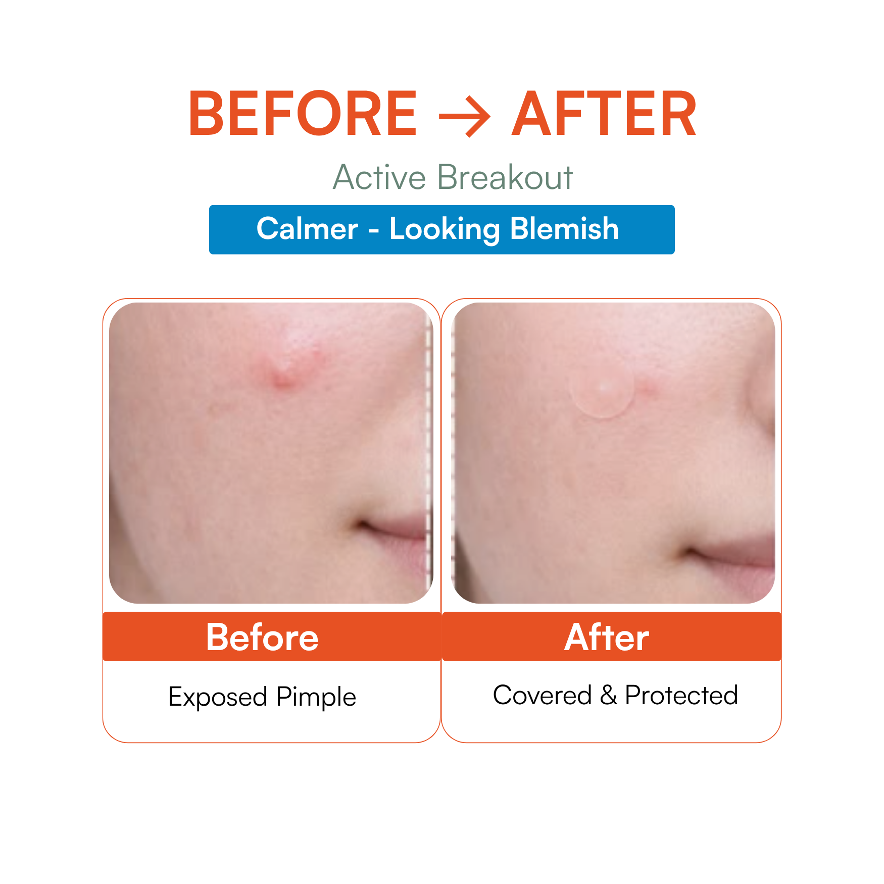 Deep Treatment Acne Patch